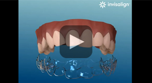 What is Invisalign?